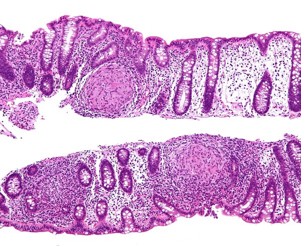 Crohnova choroba