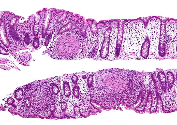 Crohnova choroba