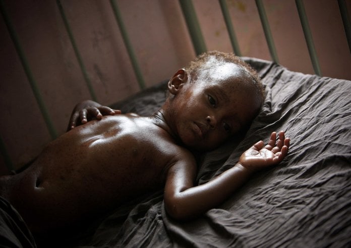 africké dítě podvýživa
