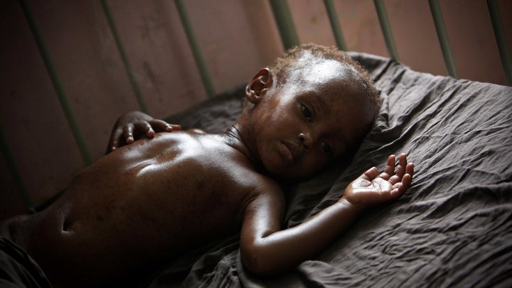 africké dítě podvýživa