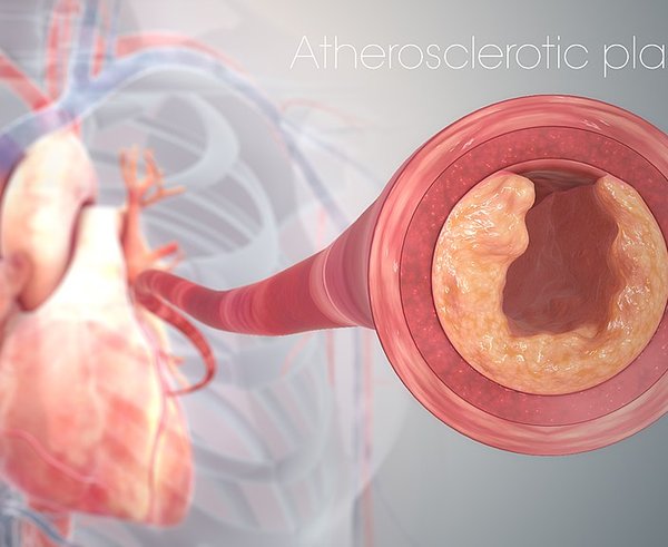 Clogged_Heart_Artery