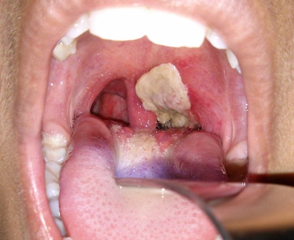 Dirty_white_pseudomembrane_classically_seen_in_diphtheria_2013-07-06_11-07