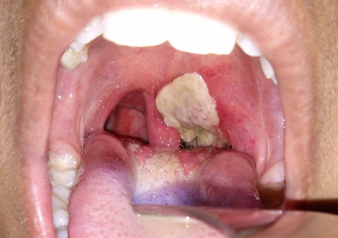 Dirty_white_pseudomembrane_classically_seen_in_diphtheria_2013-07-06_11-07