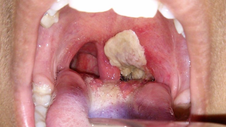 Dirty_white_pseudomembrane_classically_seen_in_diphtheria_2013-07-06_11-07