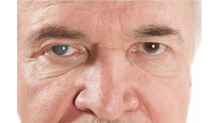 Glaukom-zeleny-zakal