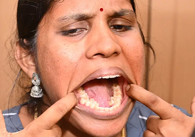 Indka Kalpana Balan má 38 zubů
