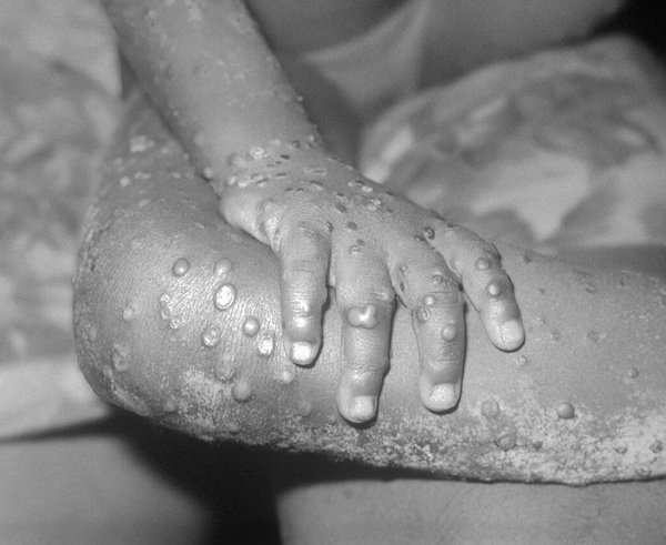 Monkeypox