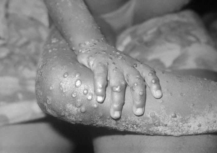 Monkeypox