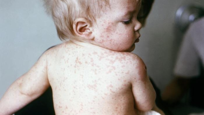 Young_boy_with_measles