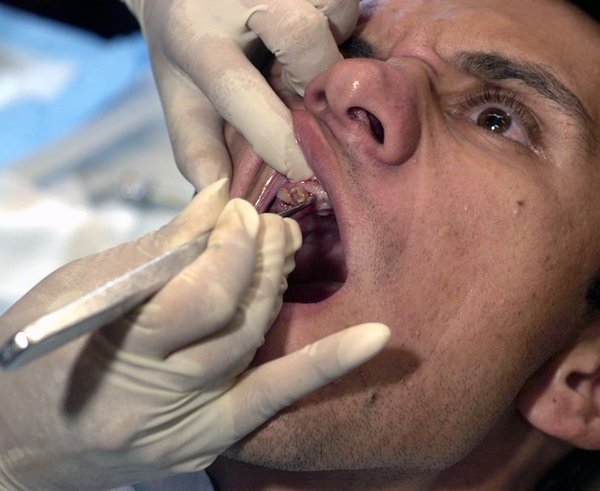 a-paraguayan-man-get-a-tooth-pulled-during-a-medical-exercise-at-cerro-membre-2afa27-1024