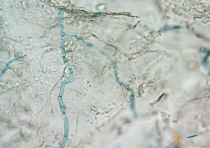 Vizualizace hyf dermatofytu (modře) v kožní tkáni pomocí světleného mikroskopu