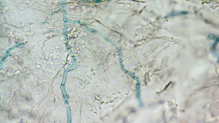 Vizualizace hyf dermatofytu (modře) v kožní tkáni pomocí světleného mikroskopu