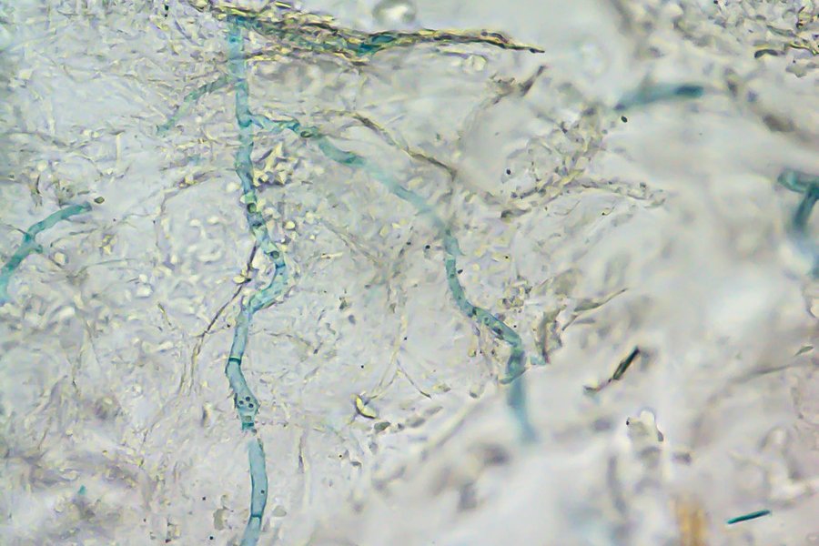 Vizualizace hyf dermatofytu (modře) v kožní tkáni pomocí světleného mikroskopu