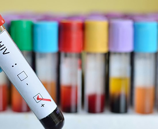 HIV