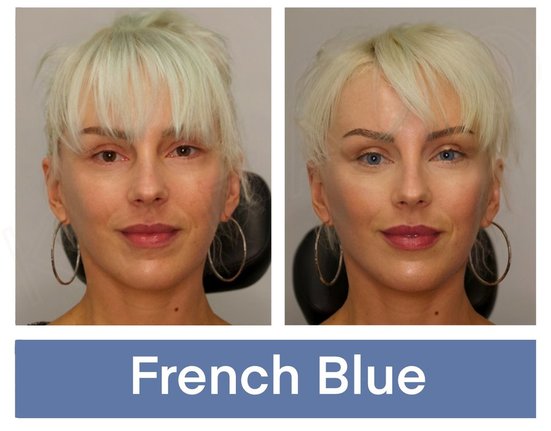 keratopigmentation+patient+eyes+with+french+blue+pigment+before+and+after+the+kerato+procedure.jpg