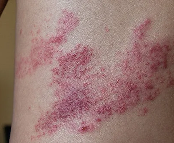 pasovy-opar-herpes-zoster-min