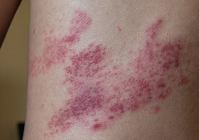 pasovy-opar-herpes-zoster-min