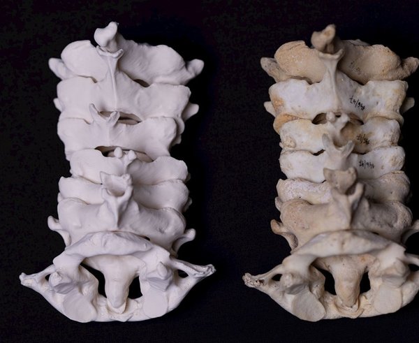 3D tisk anatomických modelů