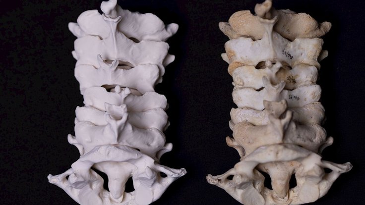 3D tisk anatomických modelů